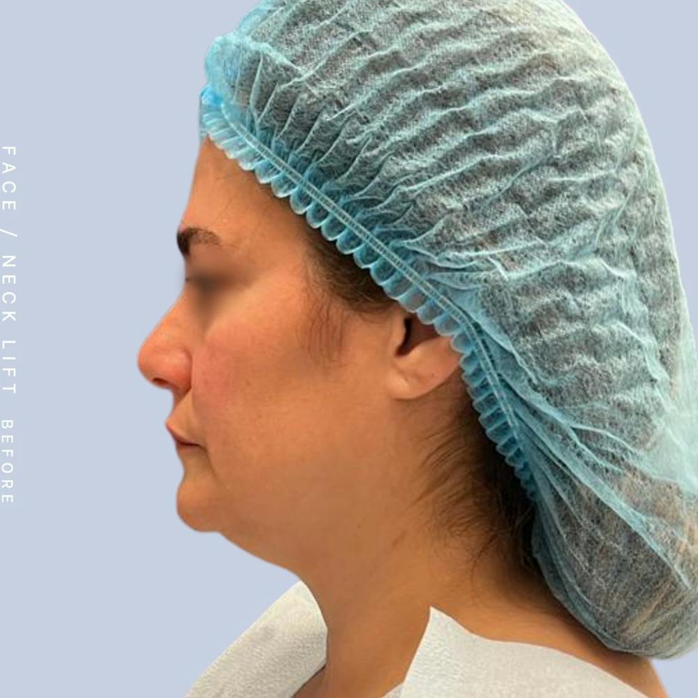 Face & Neck Before & After Gallery - Patient 122053840 - Image 3