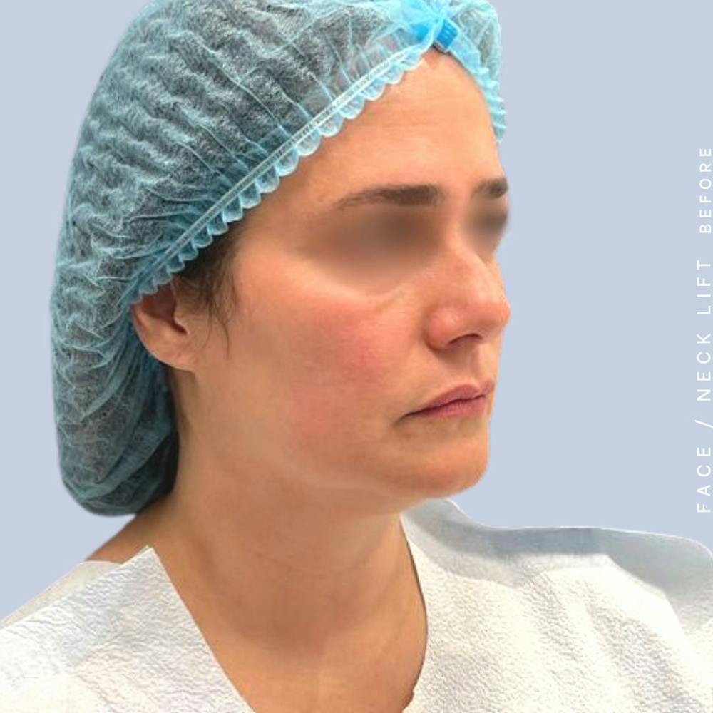 Face & Neck Before & After Gallery - Patient 122053840 - Image 5