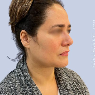 Face & Neck Before & After Gallery - Patient 122053840 - Image 6