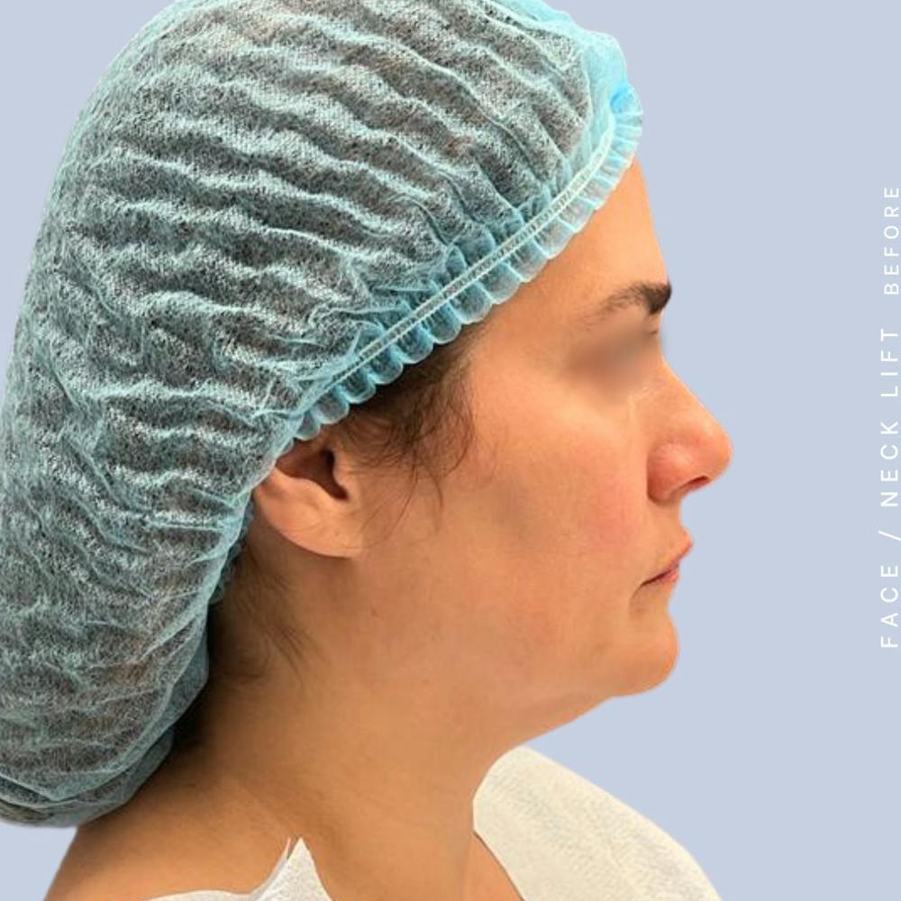 Face & Neck Before & After Gallery - Patient 122053840 - Image 7