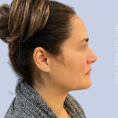 Face & Neck Before & After Gallery - Patient 122053840 - Image 8