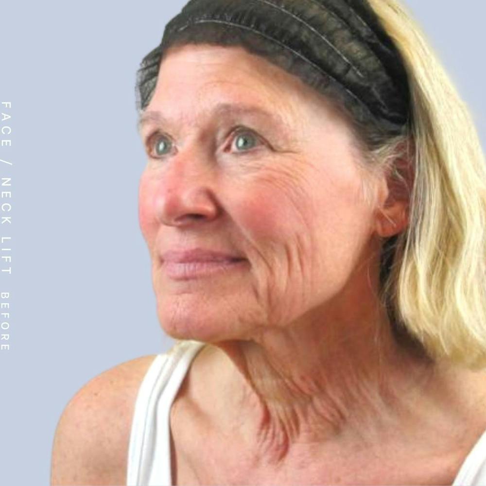 Face & Neck Before & After Gallery - Patient 122289924 - Image 3