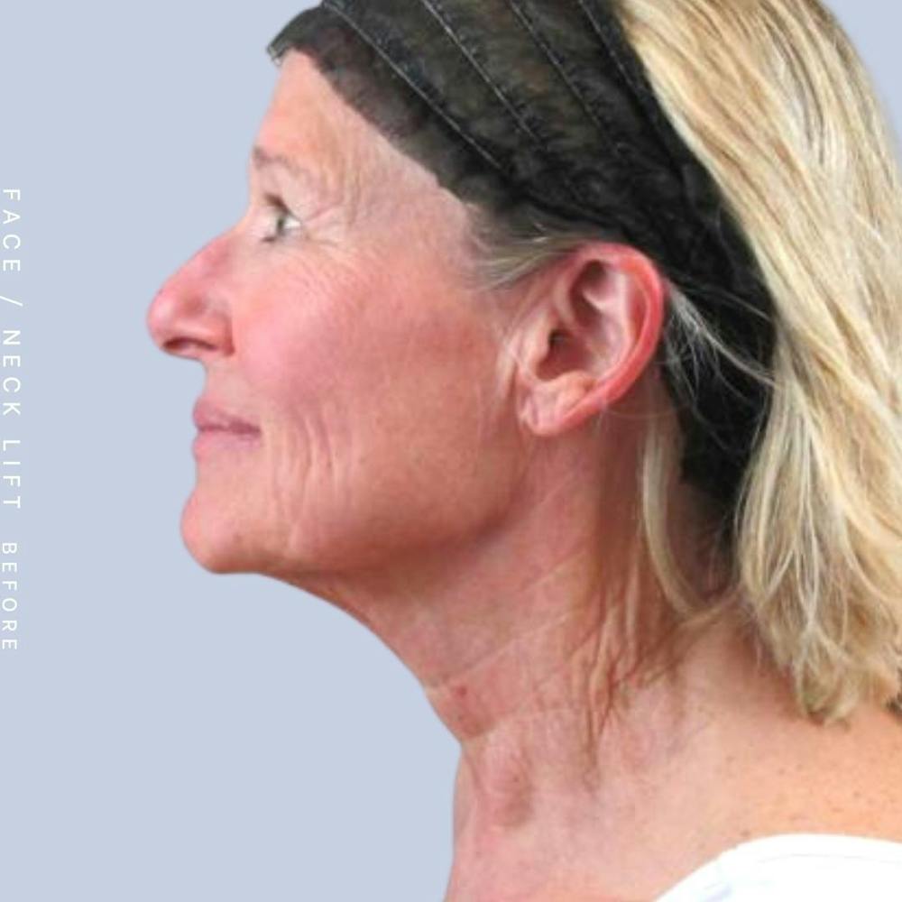 Face & Neck Before & After Gallery - Patient 122289924 - Image 5