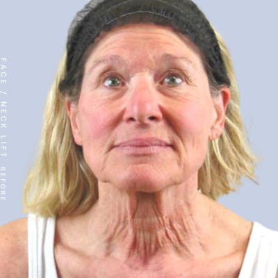 Face & Neck Gallery - Patient 122289924 - Image 1
