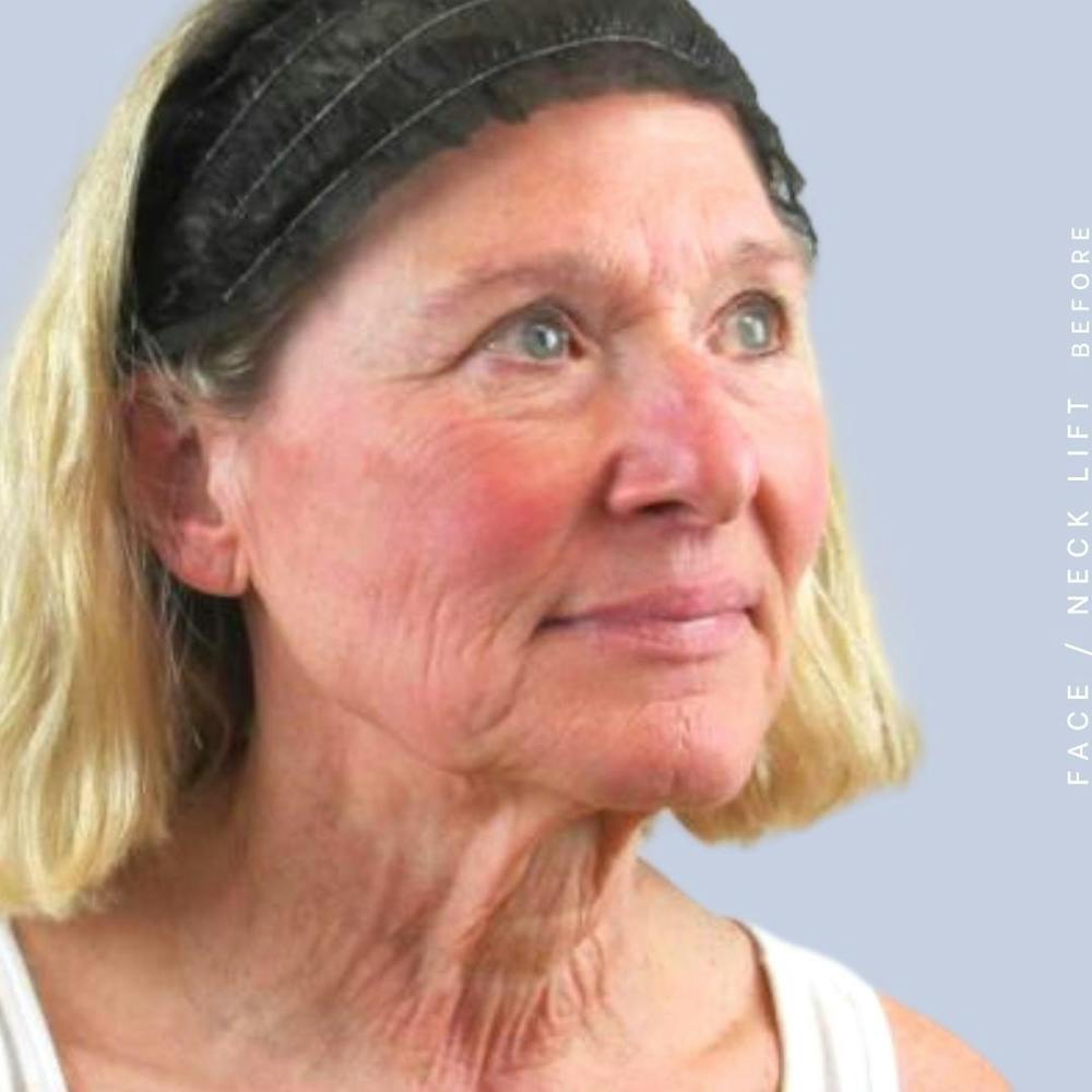 Face & Neck Before & After Gallery - Patient 122289924 - Image 7