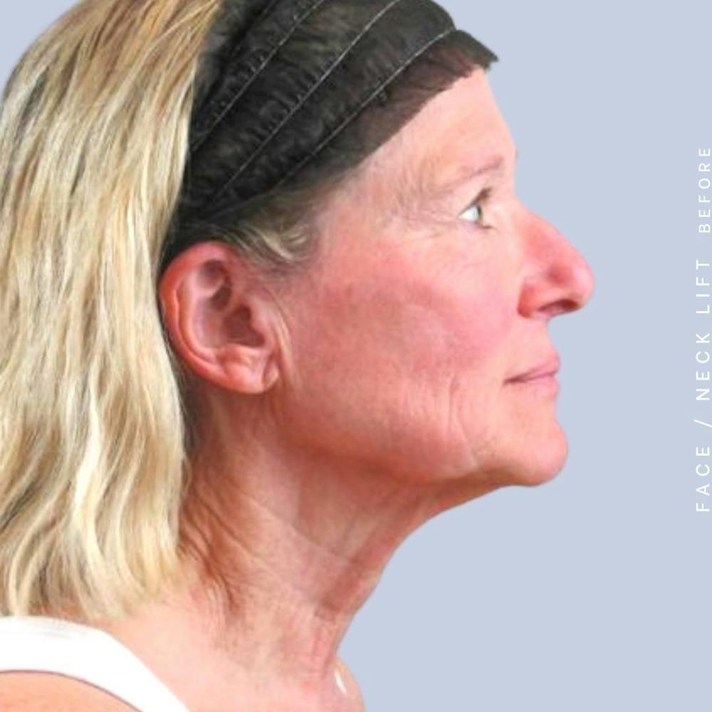Face & Neck Before & After Gallery - Patient 122289924 - Image 9