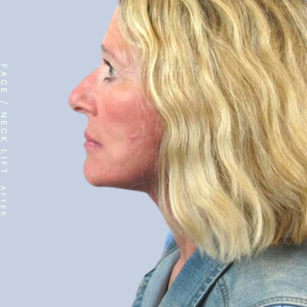 Face & Neck Before & After Gallery - Patient 122289924 - Image 6