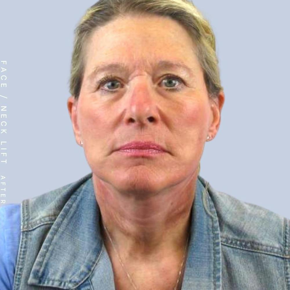 Face & Neck Before & After Gallery - Patient 122289924 - Image 2