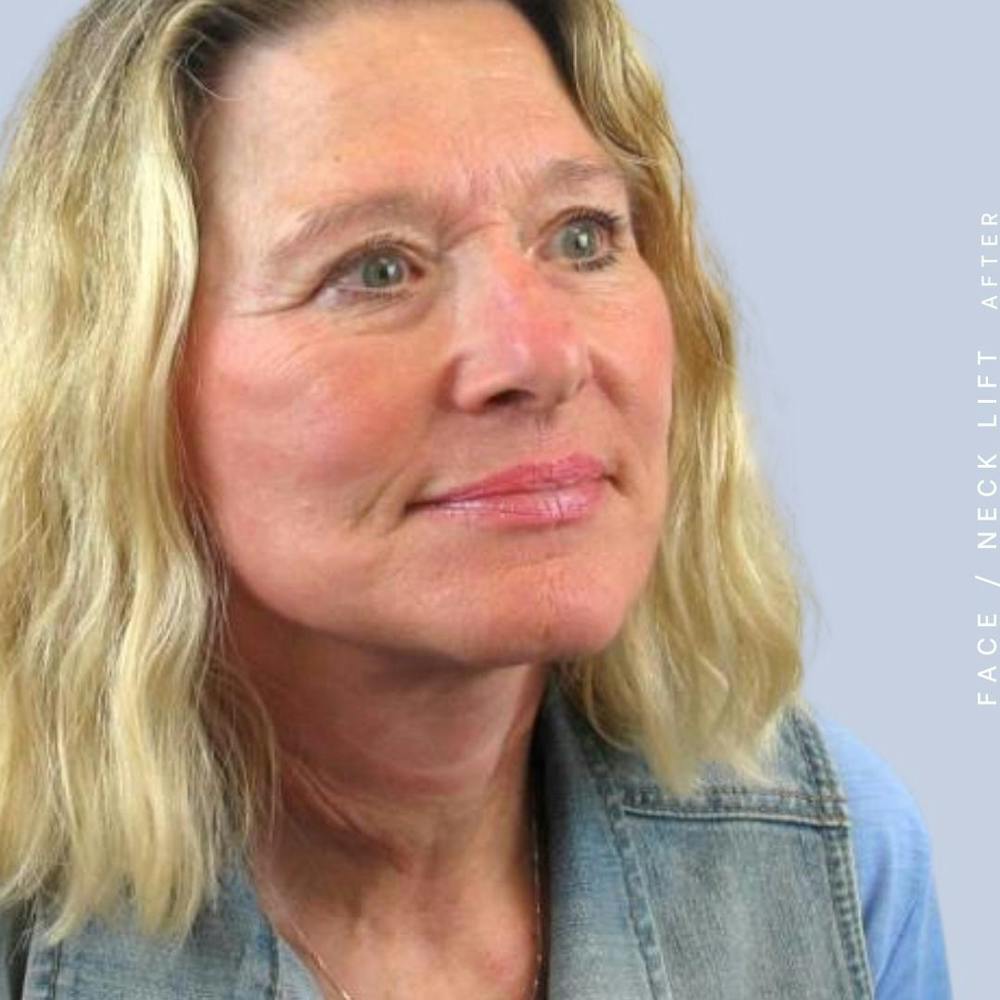 Face & Neck Before & After Gallery - Patient 122289924 - Image 8