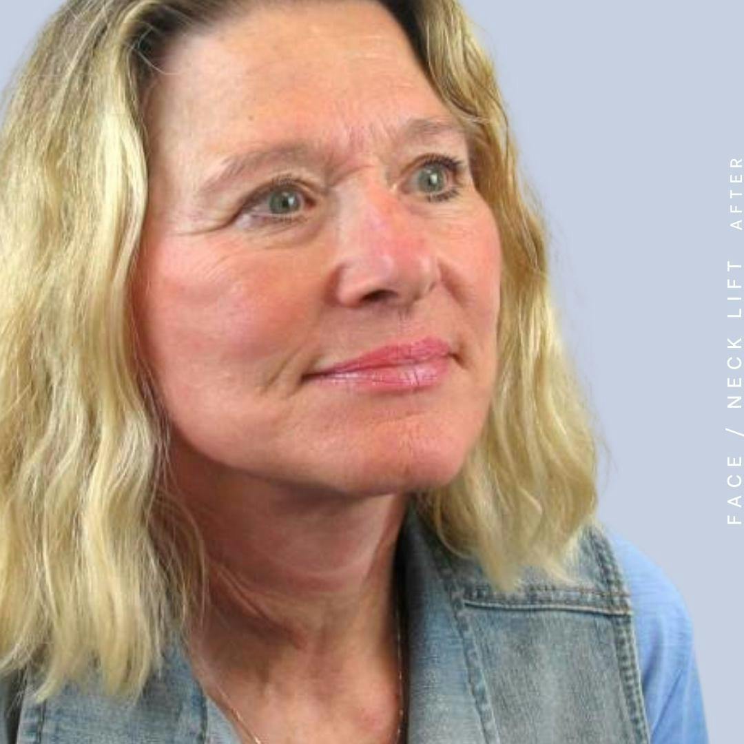 Face & Neck Before & After Gallery - Patient 122289924 - Image 8