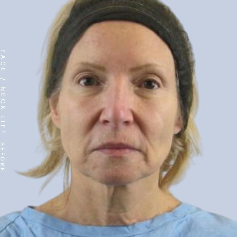 Face & Neck Before & After Gallery - Patient 119147235 - Image 1