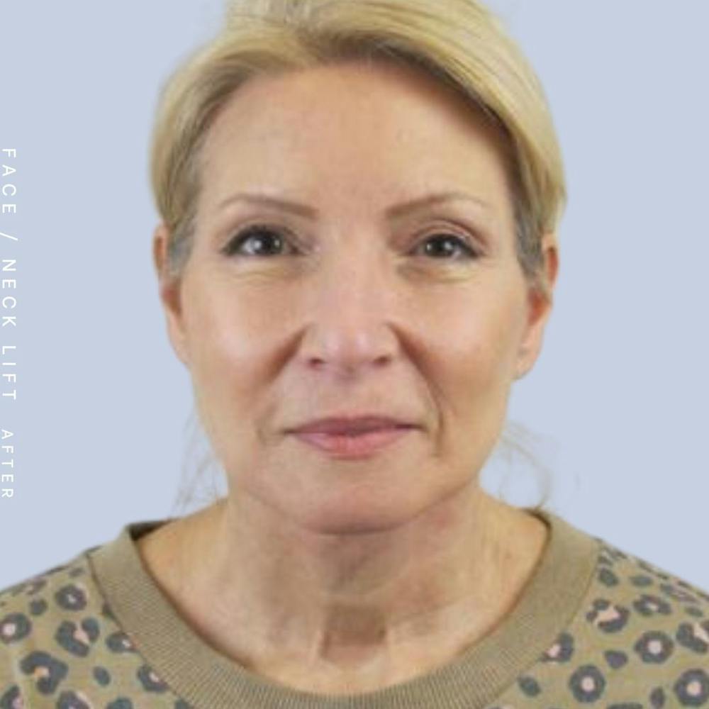 Face & Neck Before & After Gallery - Patient 119147235 - Image 2