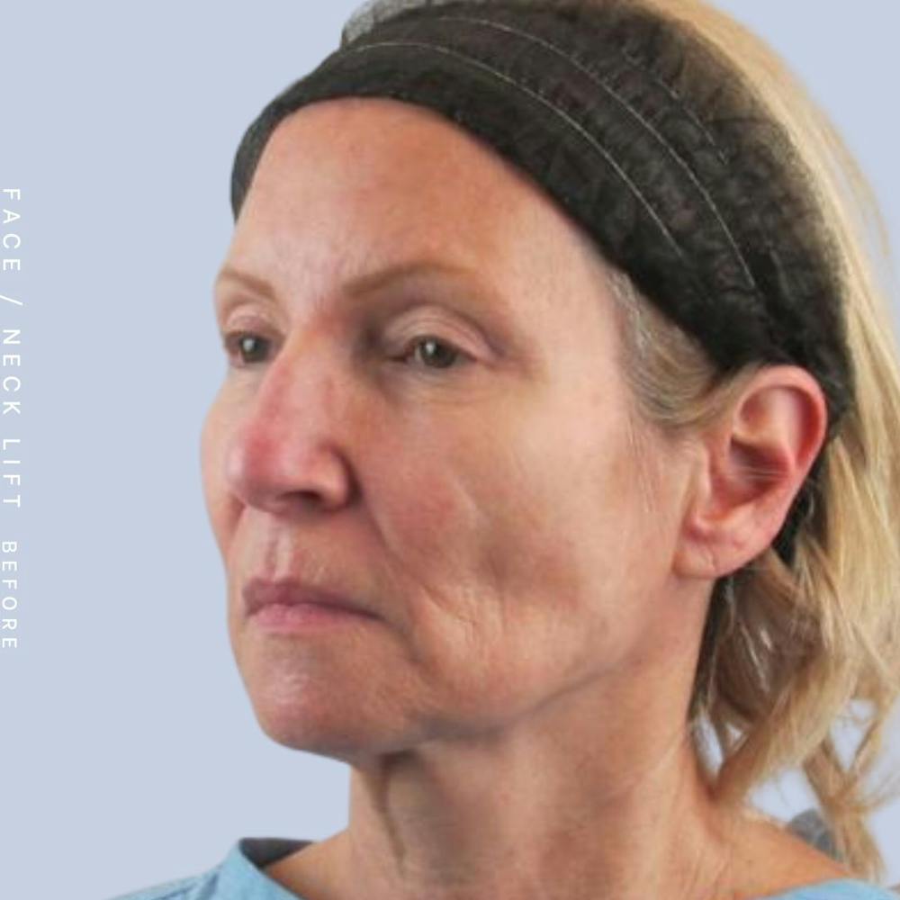 Face & Neck Before & After Gallery - Patient 119147235 - Image 3