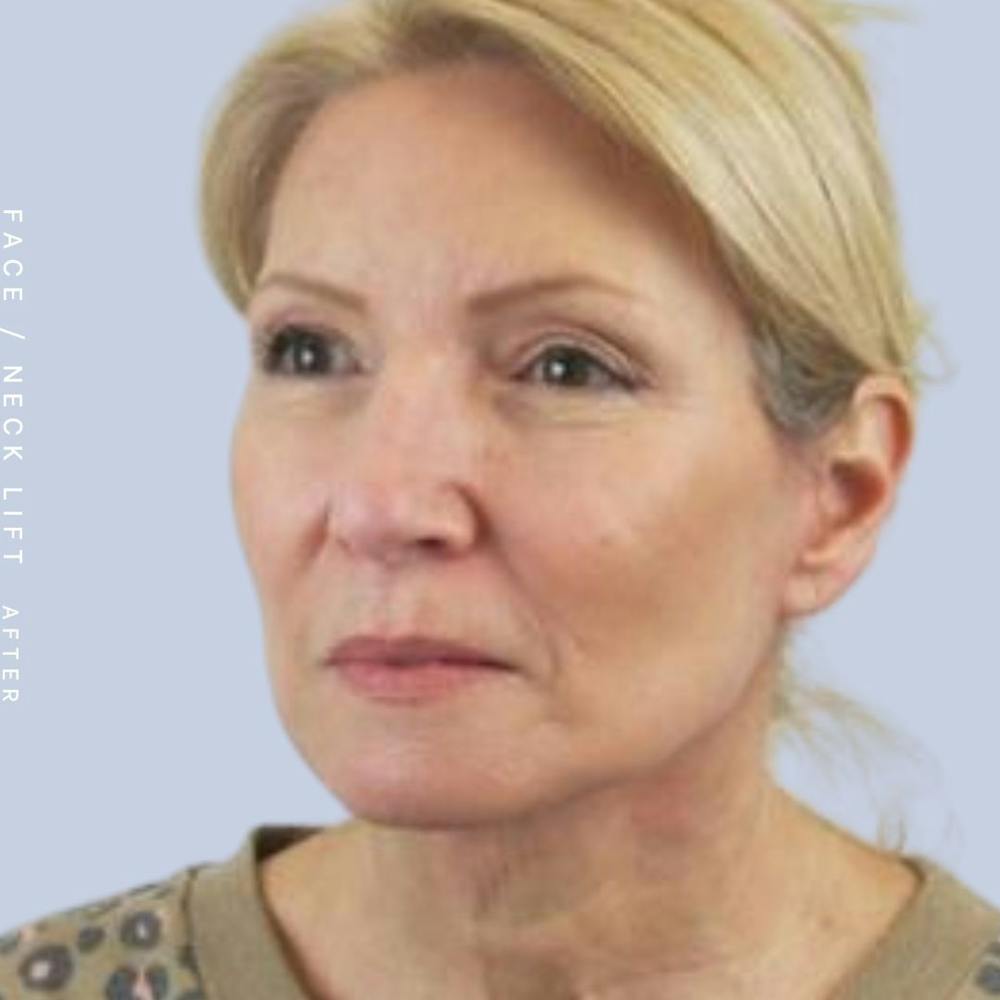 Face & Neck Before & After Gallery - Patient 119147235 - Image 4