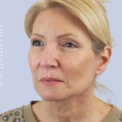 Face & Neck Before & After Gallery - Patient 119147235 - Image 4