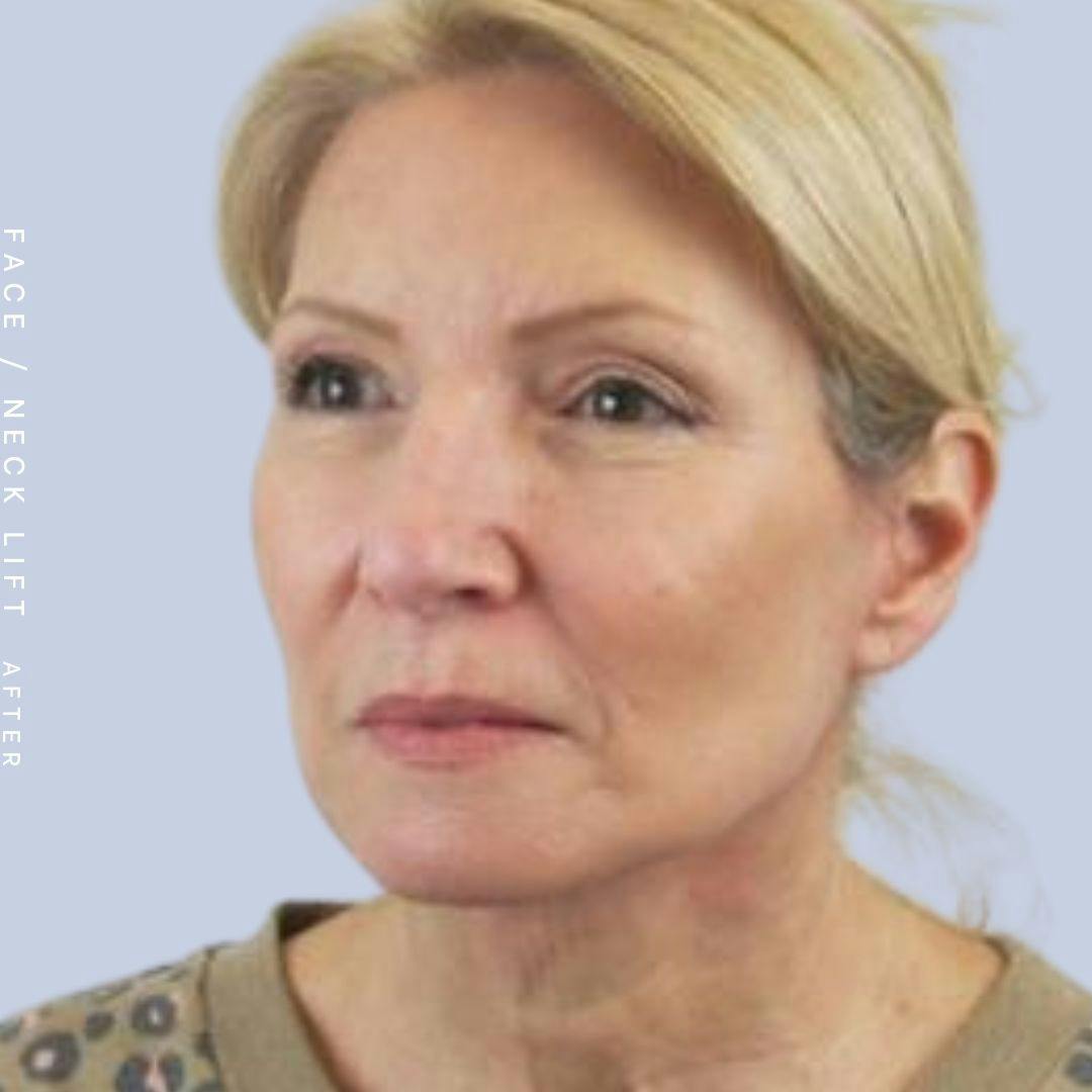 Face & Neck Before & After Gallery - Patient 119147235 - Image 4