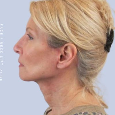 Face & Neck Before & After Gallery - Patient 119147235 - Image 6
