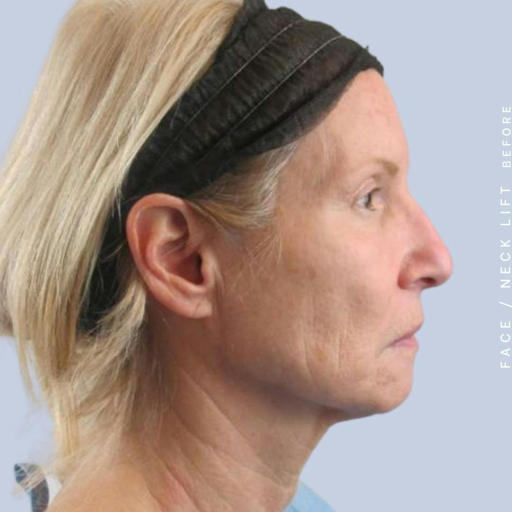 Face & Neck Before & After Gallery - Patient 119147235 - Image 7