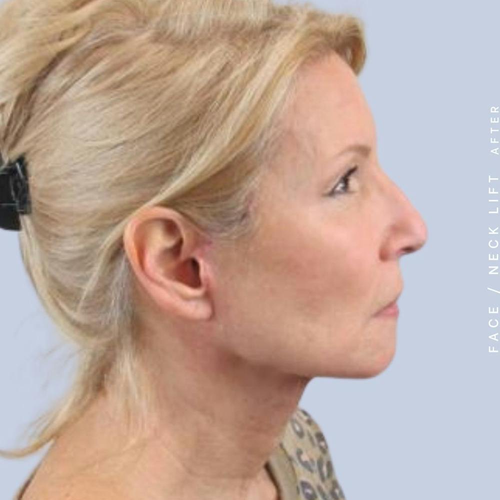 Face & Neck Before & After Gallery - Patient 119147235 - Image 8