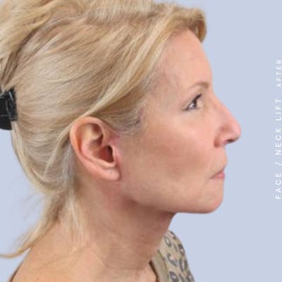 Face & Neck Before & After Gallery - Patient 119147235 - Image 8