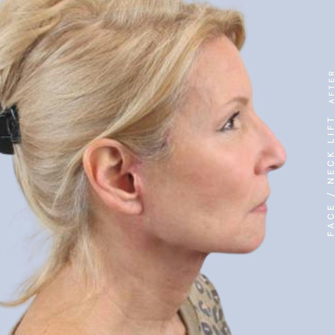 Face & Neck Before & After Gallery - Patient 119147235 - Image 8