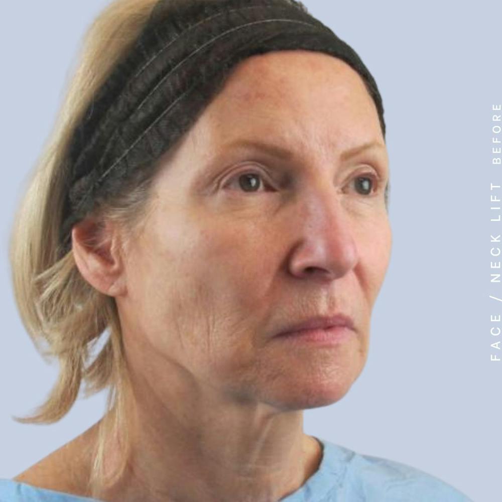 Face & Neck Before & After Gallery - Patient 119147235 - Image 9