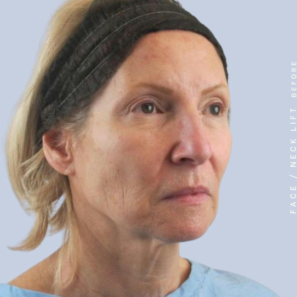 Face & Neck Before & After Gallery - Patient 119147235 - Image 9
