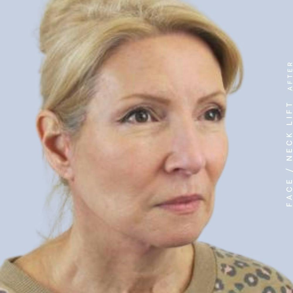 Face & Neck Before & After Gallery - Patient 119147235 - Image 10