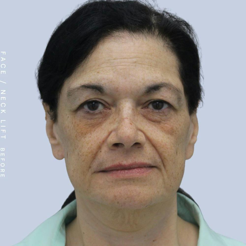 Face & Neck Before & After Gallery - Patient 120868654 - Image 1