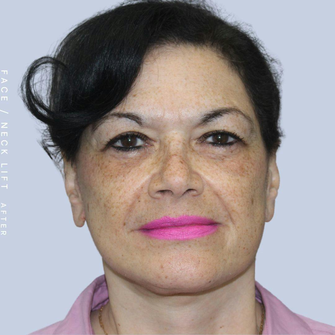 Face & Neck Before & After Gallery - Patient 120868654 - Image 2