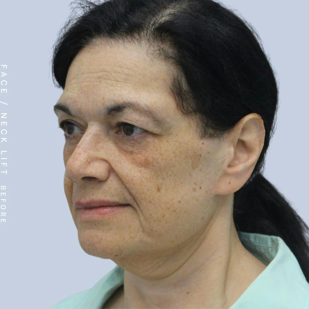 Face & Neck Before & After Gallery - Patient 120868654 - Image 3