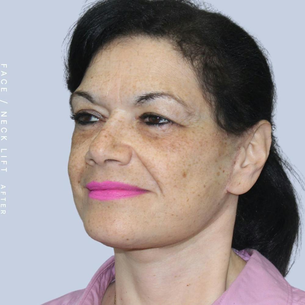 Face & Neck Before & After Gallery - Patient 120868654 - Image 4