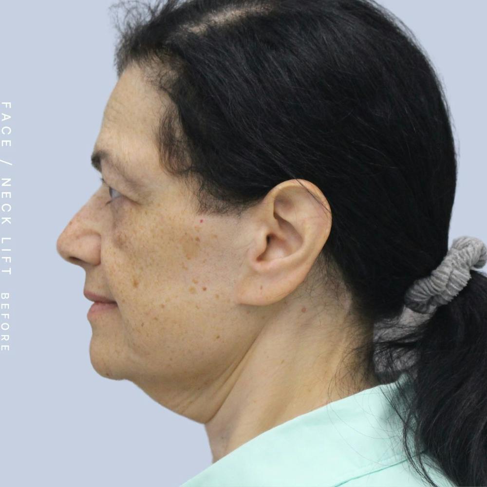 Face & Neck Before & After Gallery - Patient 120868654 - Image 5