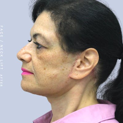 Face & Neck Before & After Gallery - Patient 120868654 - Image 6