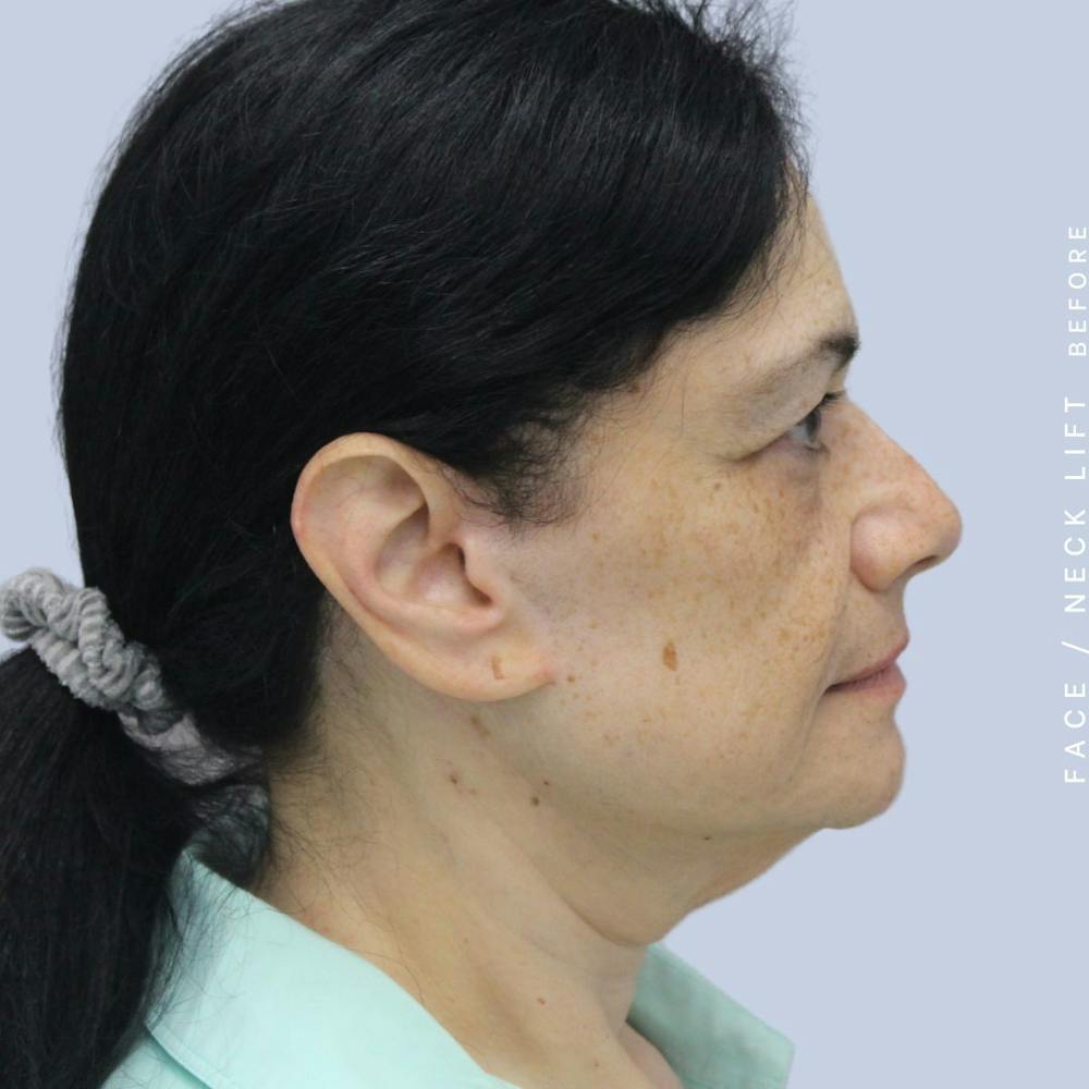Face & Neck Before & After Gallery - Patient 120868654 - Image 7
