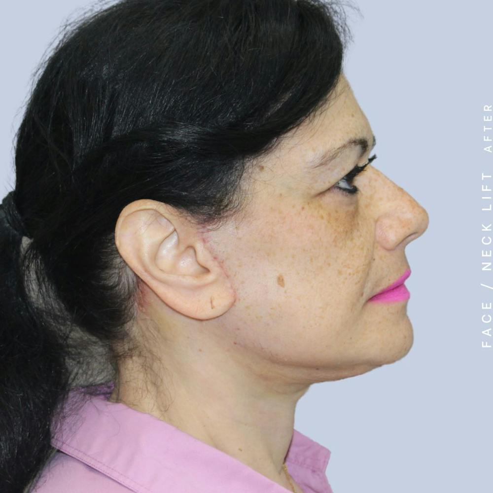 Face & Neck Before & After Gallery - Patient 120868654 - Image 8