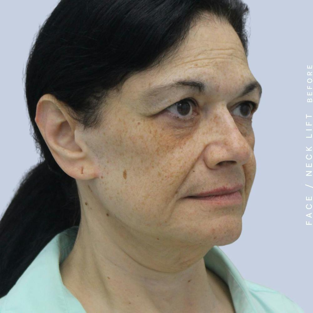 Face & Neck Before & After Gallery - Patient 120868654 - Image 9