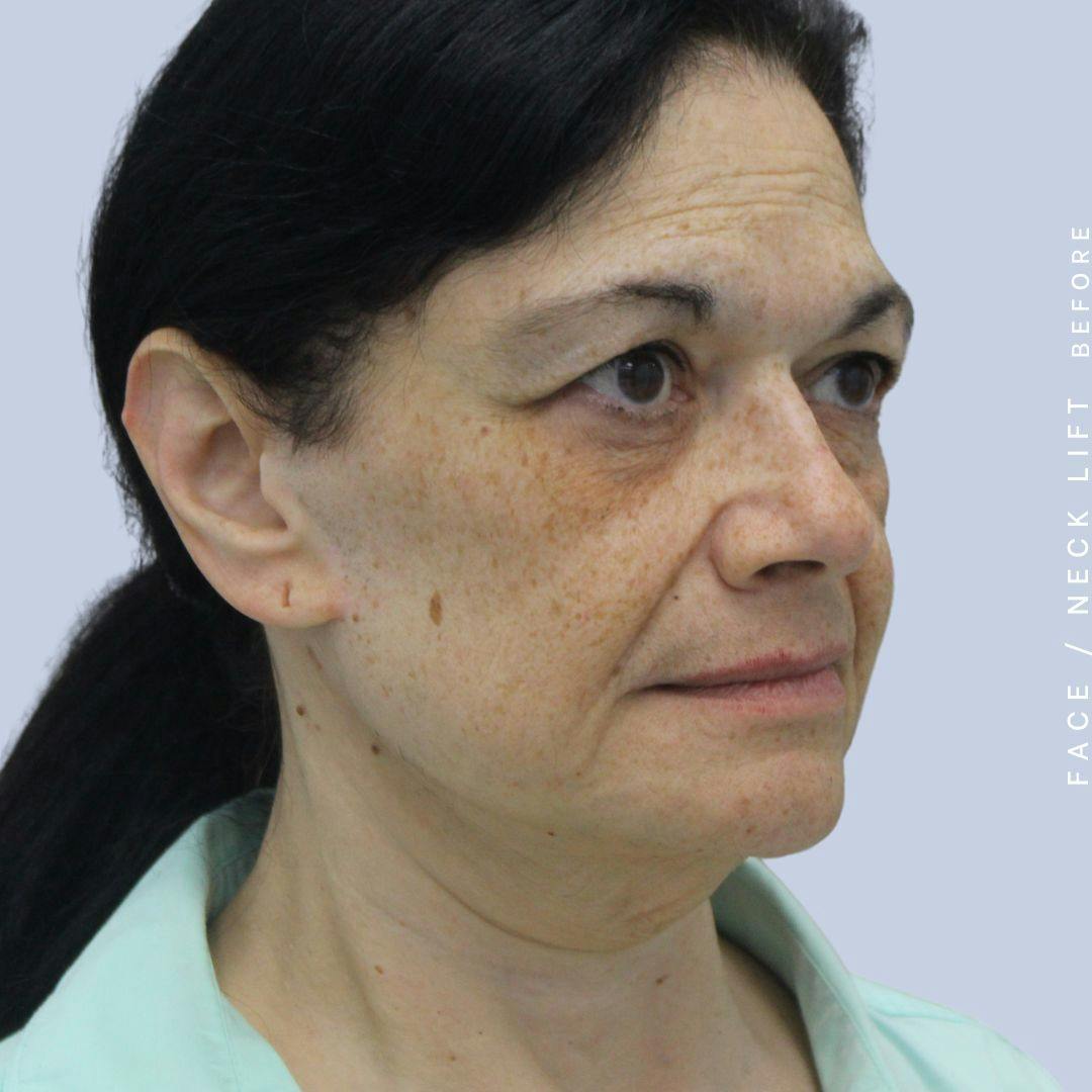 Face & Neck Before & After Gallery - Patient 120868654 - Image 9