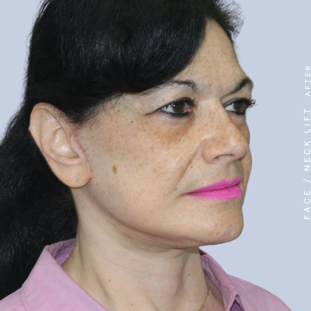 Face & Neck Before & After Gallery - Patient 120868654 - Image 10