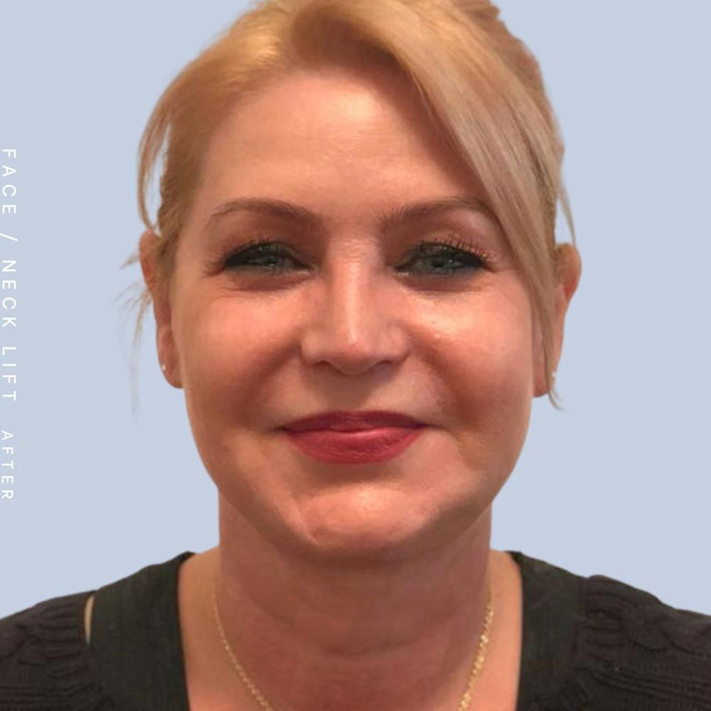 Face & Neck Before & After Gallery - Patient 121359031 - Image 2