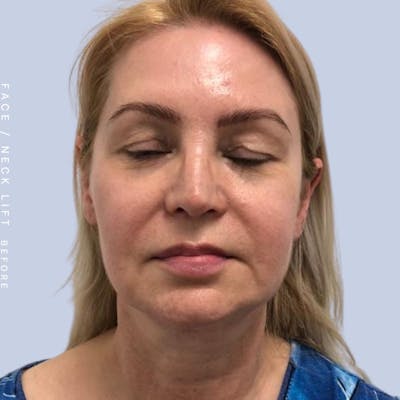 Face & Neck Before & After Gallery - Patient 121359031 - Image 1