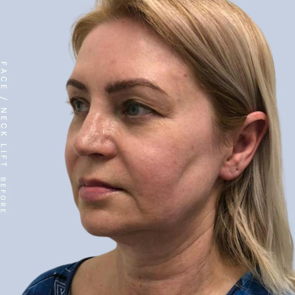 Face & Neck Before & After Gallery - Patient 121359031 - Image 3