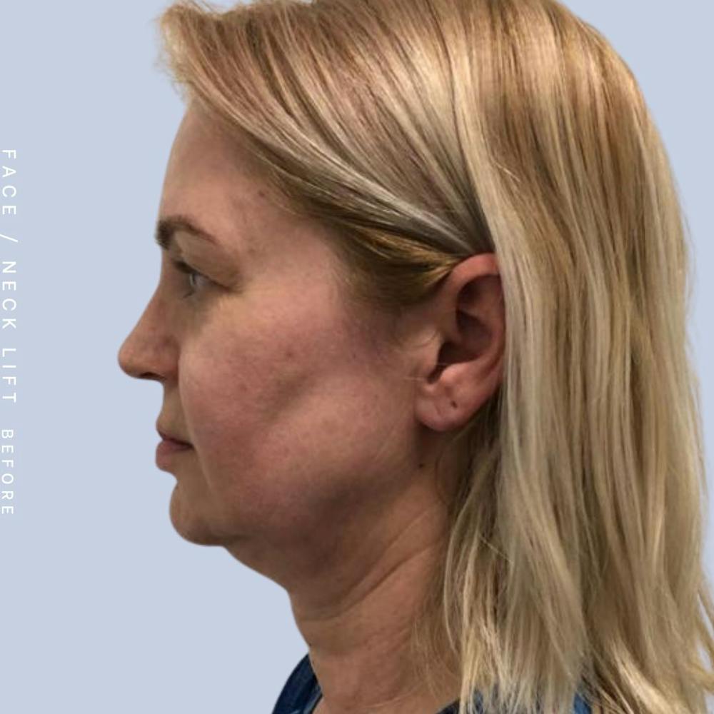Face & Neck Before & After Gallery - Patient 121359031 - Image 5
