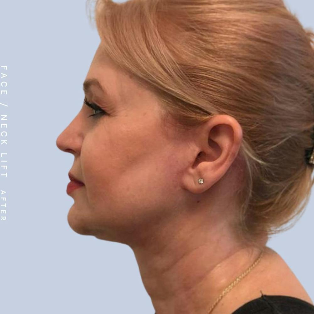 Face & Neck Before & After Gallery - Patient 121359031 - Image 6