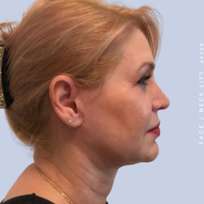 Face & Neck Before & After Gallery - Patient 121359031 - Image 8