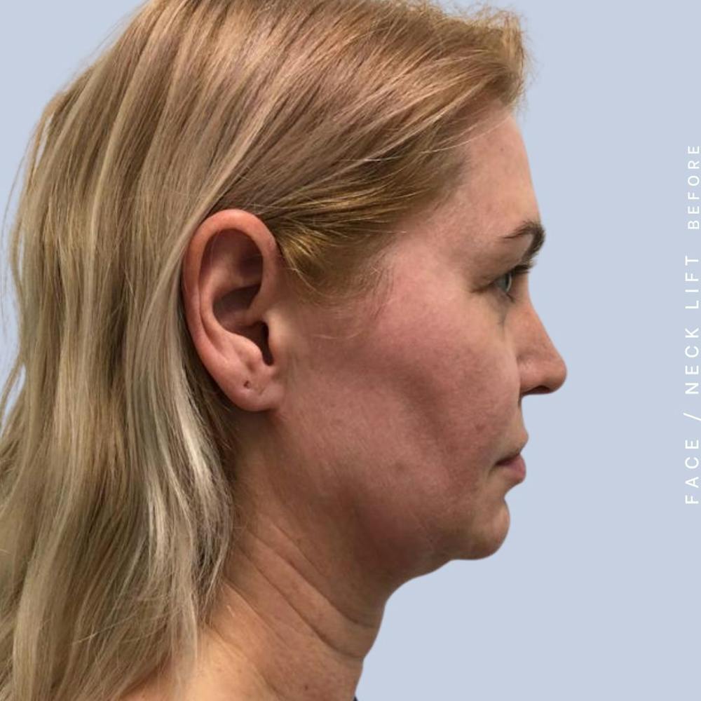 Face & Neck Before & After Gallery - Patient 121359031 - Image 7