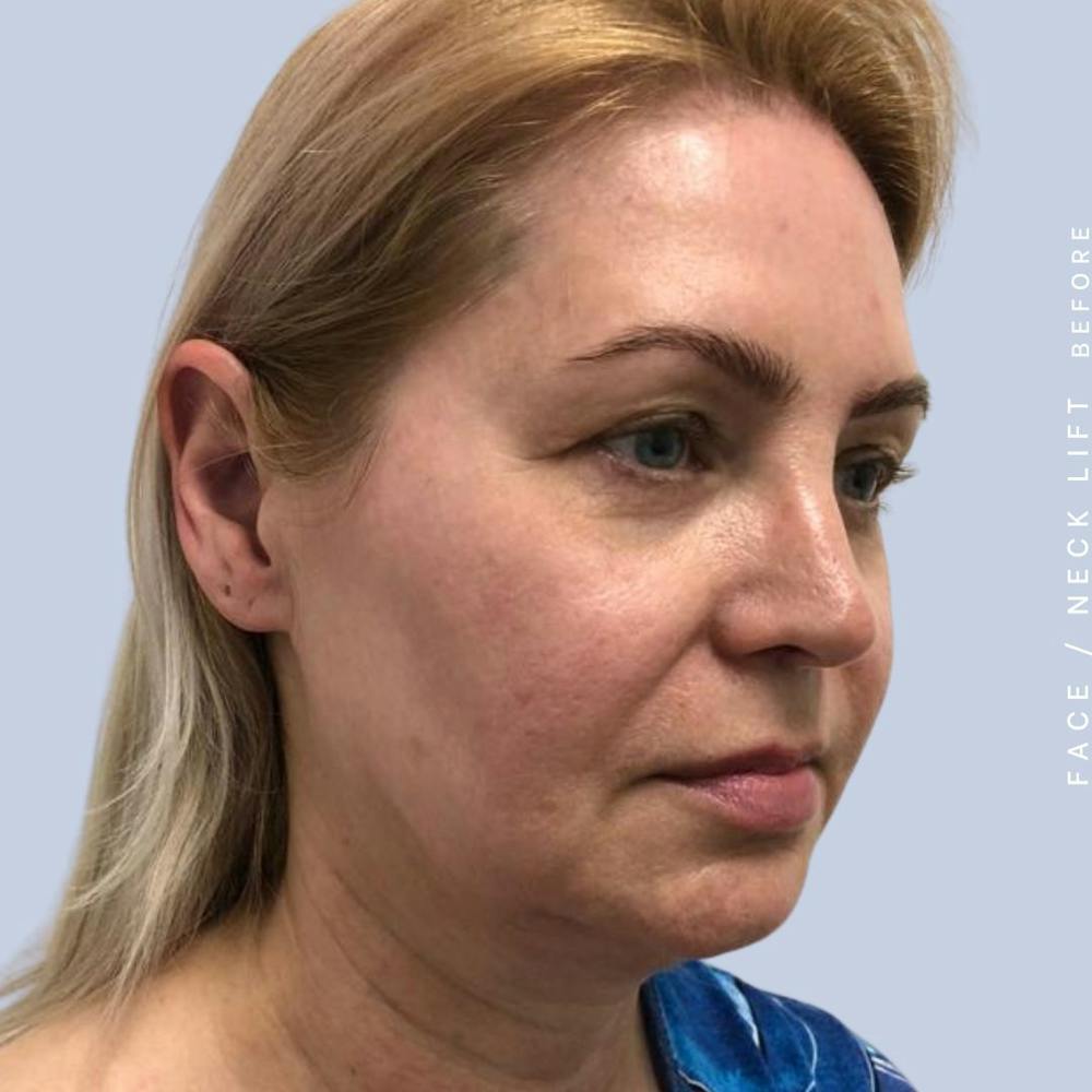 Face & Neck Before & After Gallery - Patient 121359031 - Image 9