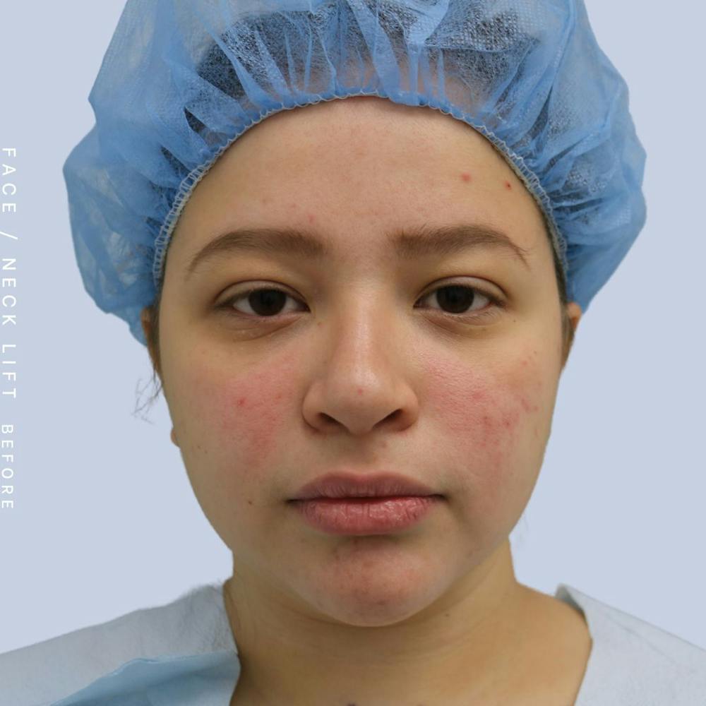 Face & Neck Before & After Gallery - Patient 108707434 - Image 1