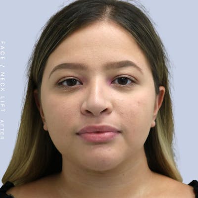 Face & Neck Before & After Gallery - Patient 108707434 - Image 2