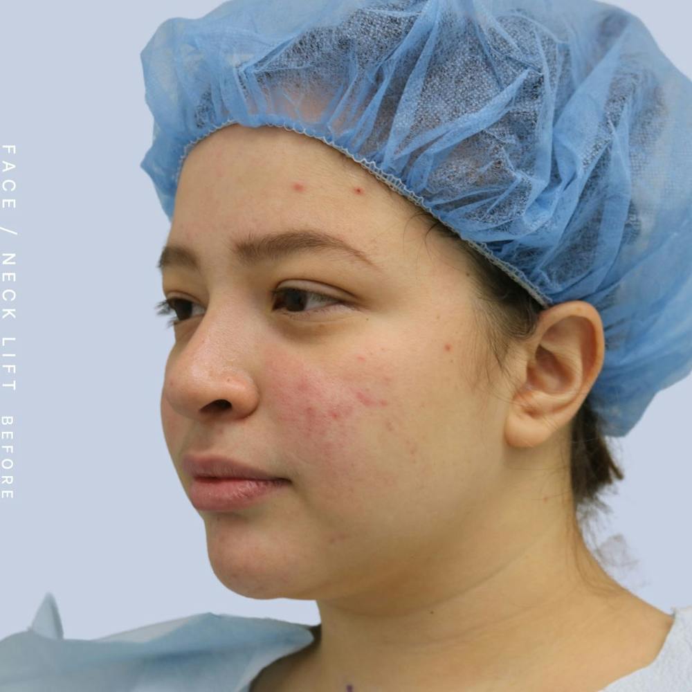 Face & Neck Before & After Gallery - Patient 108707434 - Image 3